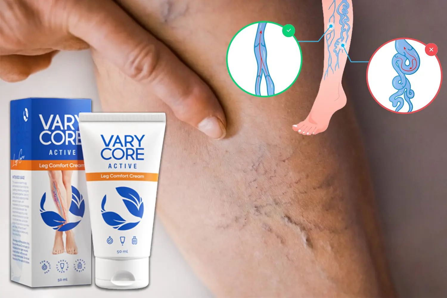 Varycore para las varices